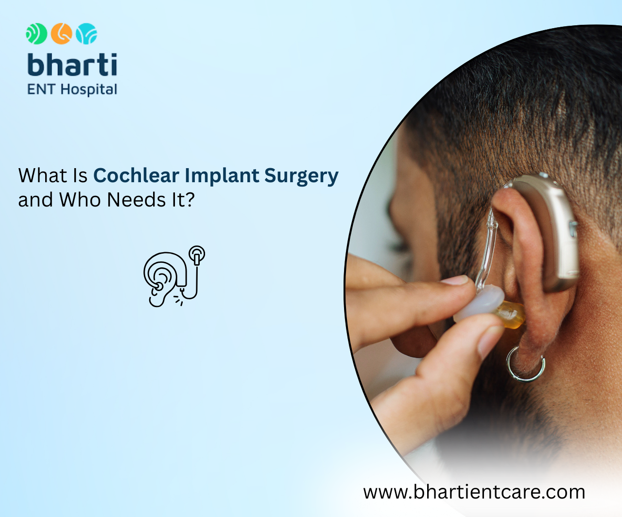 What Is Cochlear Implant Surgery and Who Needs It?